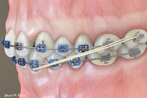 underbite metal bracket rubber bands|types of rubber bands for braces.